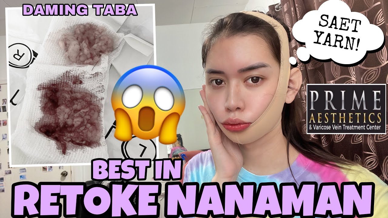 BUCCAL FAT REMOVAL NO MORE CHUBBY CHEEKS FOR THE GOOD ITEM NAK! 🤣 || VLOG#150 JanaLarman