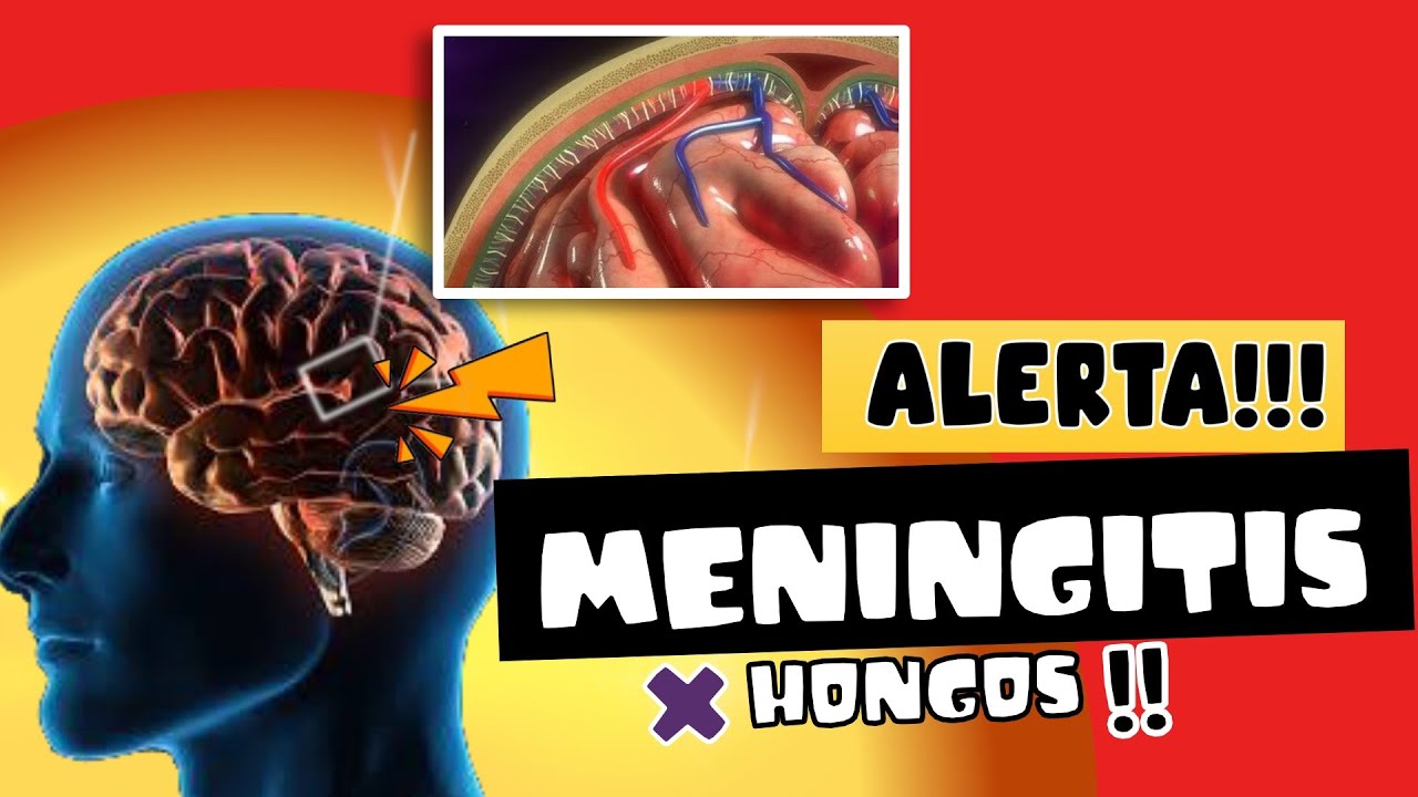 ALERTA  ⚠️ MENINGITIS POR HONGO - &iquest;RIESGO DE EPIDEMIA? &iquest;C&Oacute;MO SE TRANSMITE?  😱😱😱