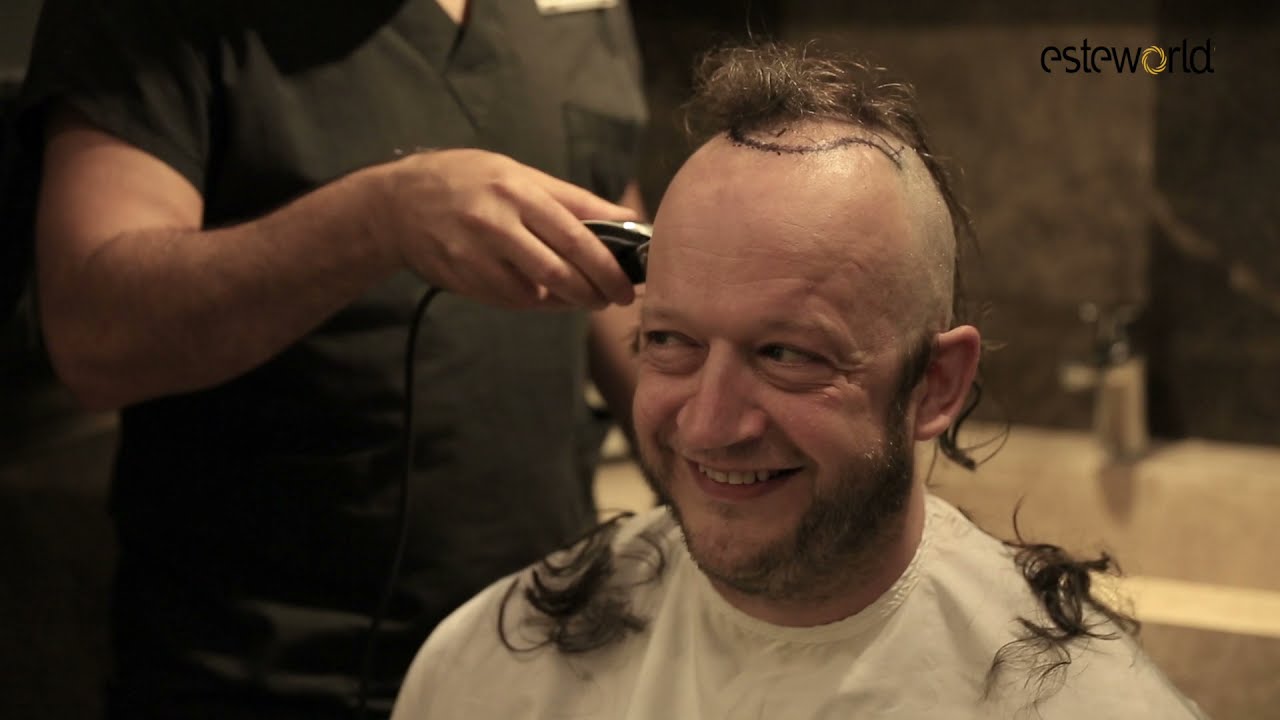 Acteur Rein Hofman haarransplantatie bij Esteworld