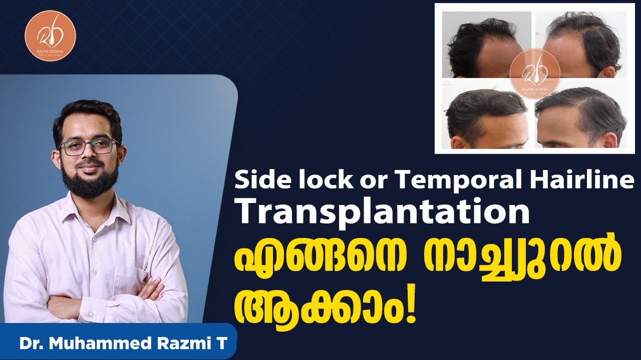 Side lock or Temporal hairline transplantation എങ്ങനെ നാച്ച്യുറൽ ആക്കാം! | side lock hair cutting