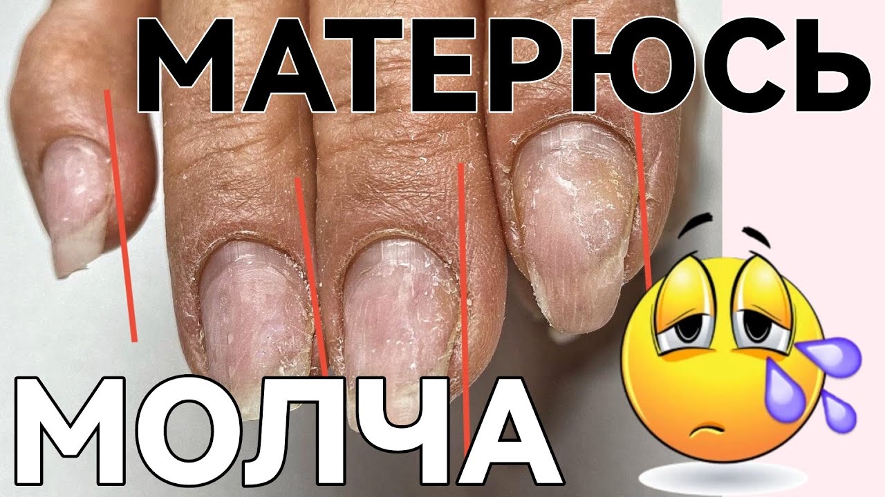 СЛОЖНАЯ КОРРЕКЦИЯ / спиленные боковые стенки / клюющие ногти / маникюр от другого мастера до и после