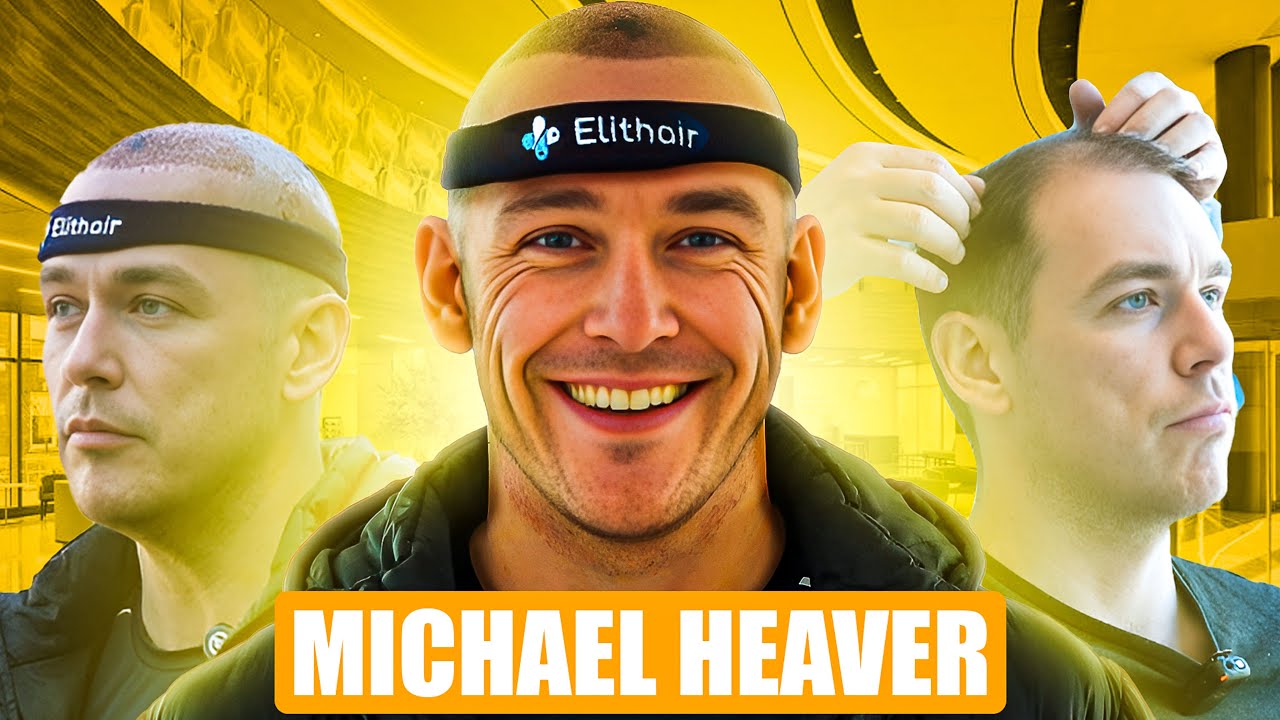 Inside My Hair Transplant Journey – Michael Heaver's Clinic Visit!