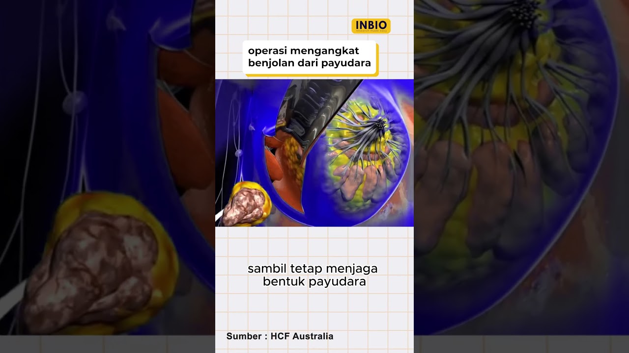 Operasi mengangkat benjolan payudara