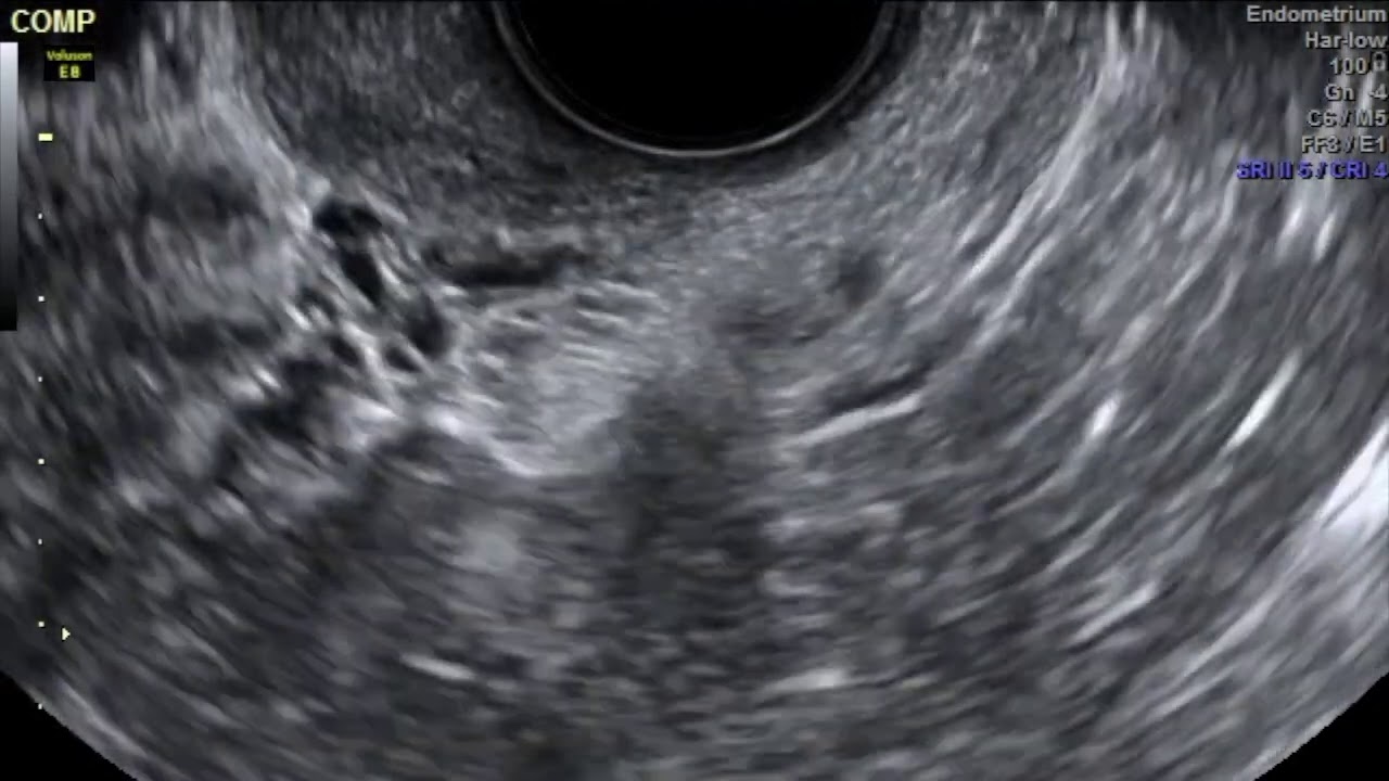Video 12: Uterosacral ligaments in deep endometriosis caused by hydroureter