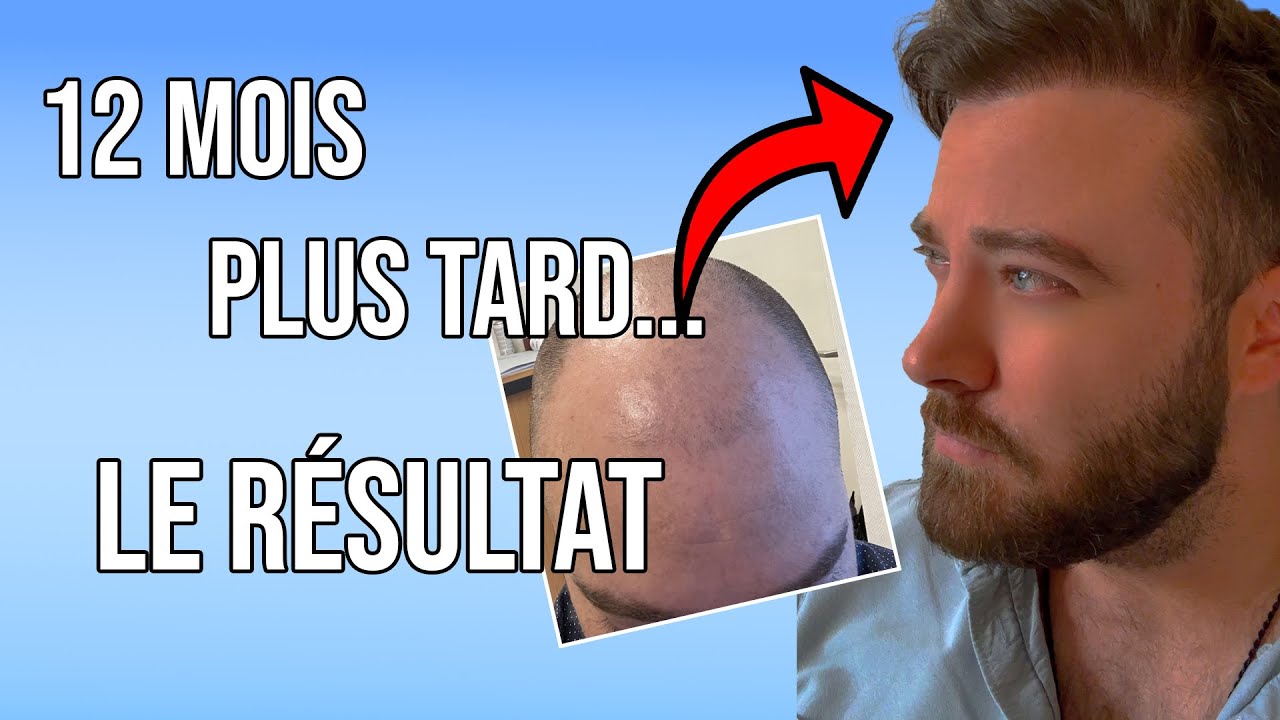 Greffe de cheveux : la suite (12 mois plus tard, le résultat 😱) +FAQ