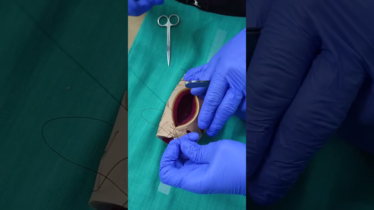 Babu and Magon Technique of Uterine closure during LSCS.