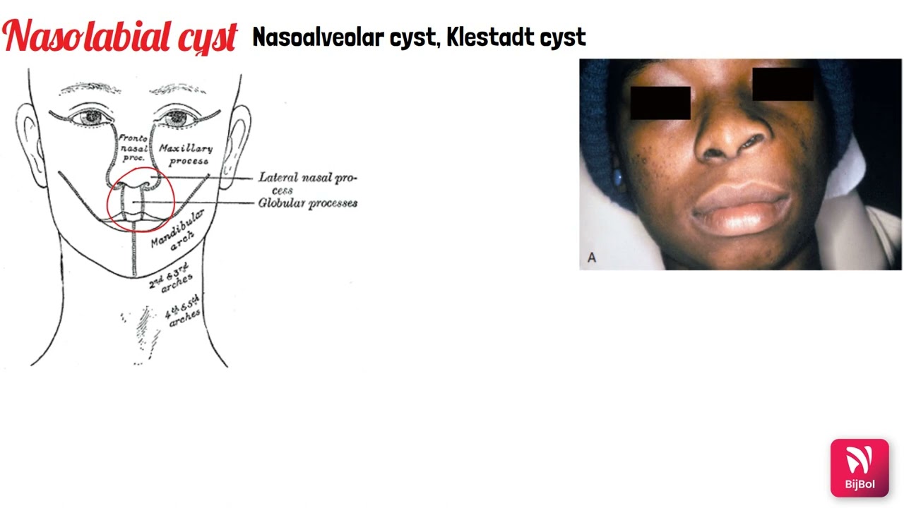 NON ODONTOGENIC CYSTS