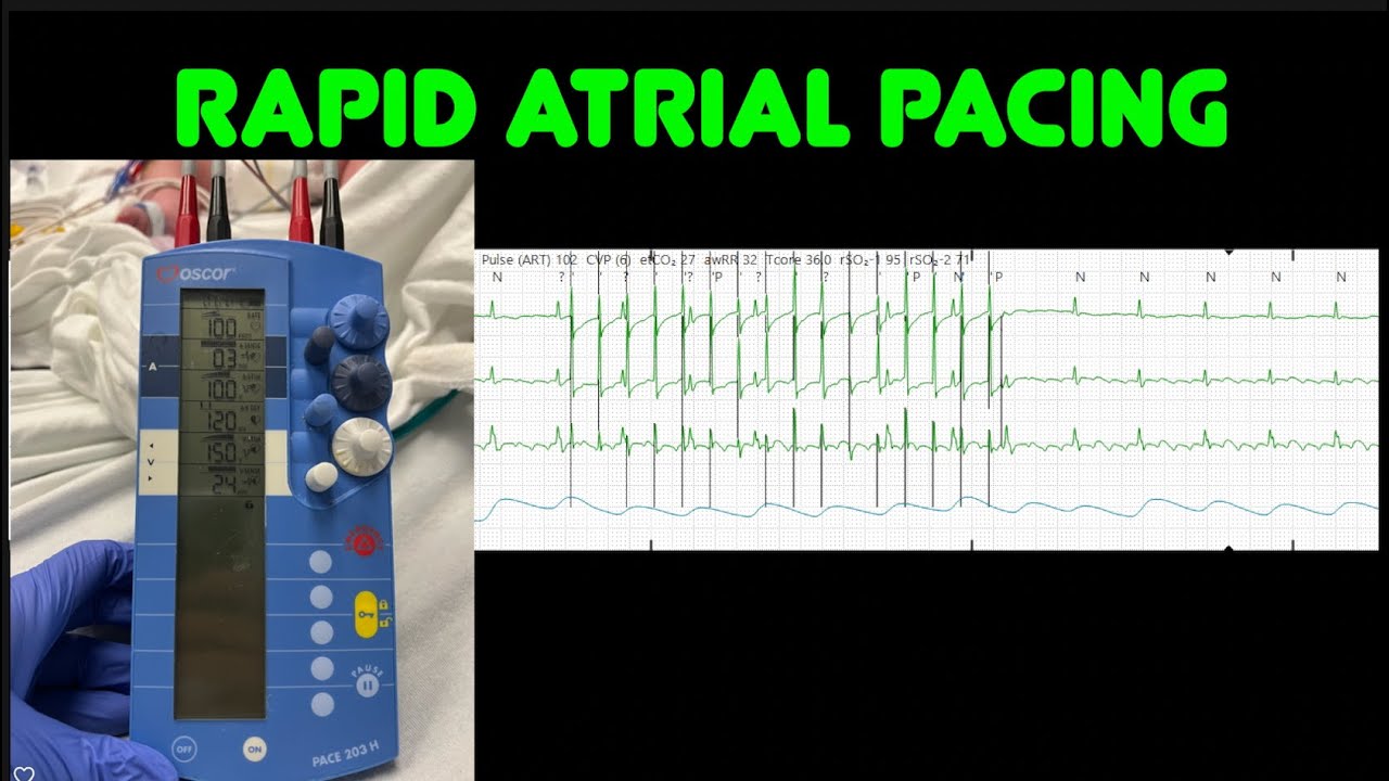 Rapid atrial pacing