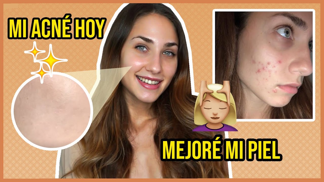 Cómo mejoré mi piel con ACNÉ | Roaccutan | Juli Berea