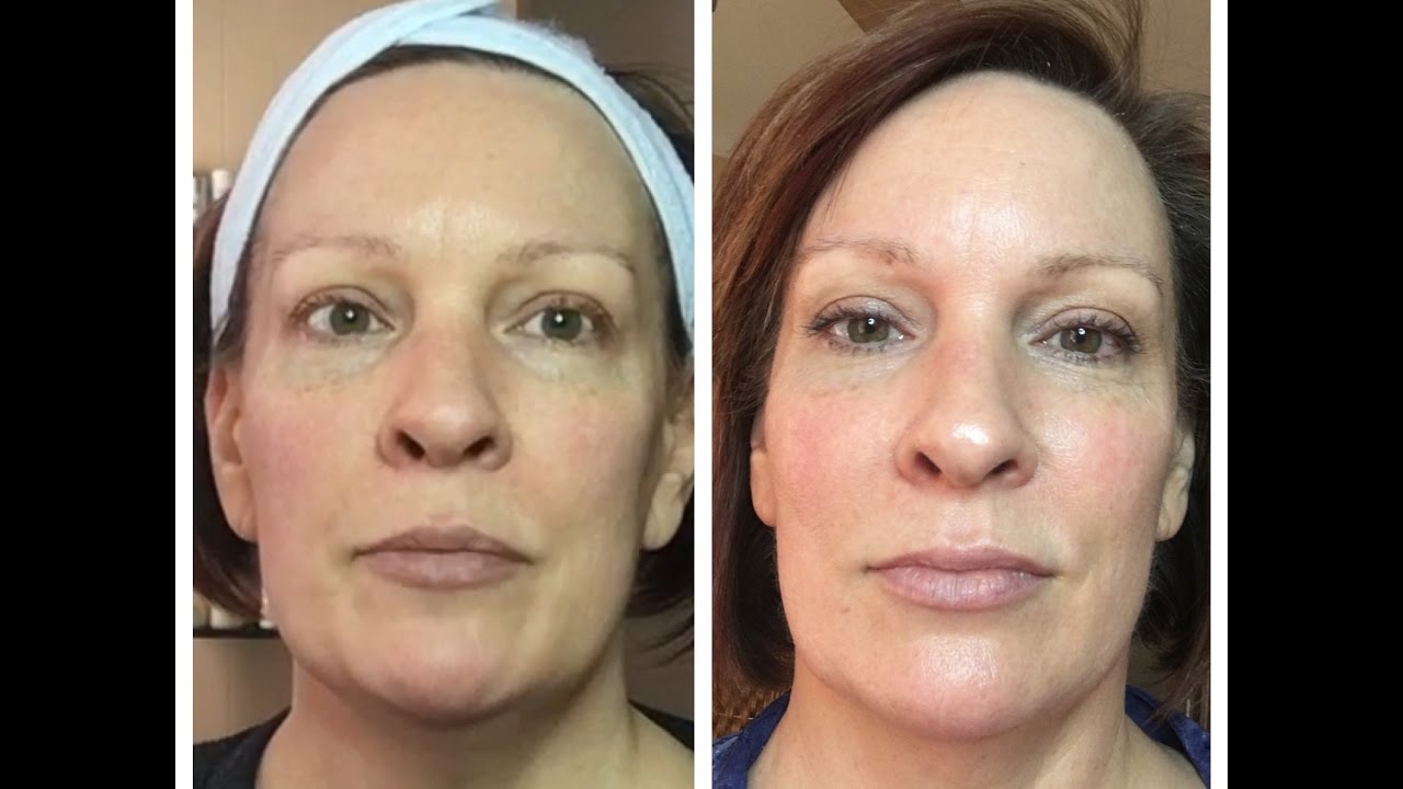RESULTS ARE IN 12 Day Home Use Microcurrent Challenge