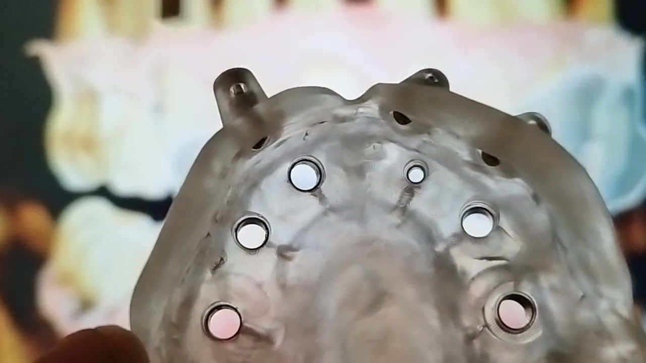 Így készül a tökéletes mosoly digitális tervezéssel – All-on-4/6 megoldások | Dekor Dent Implant Bt.