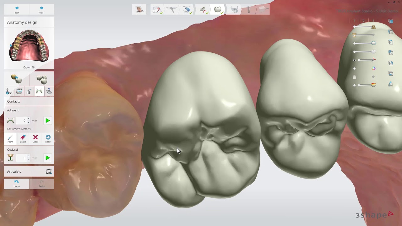 Novidades do Implant Studio 2017