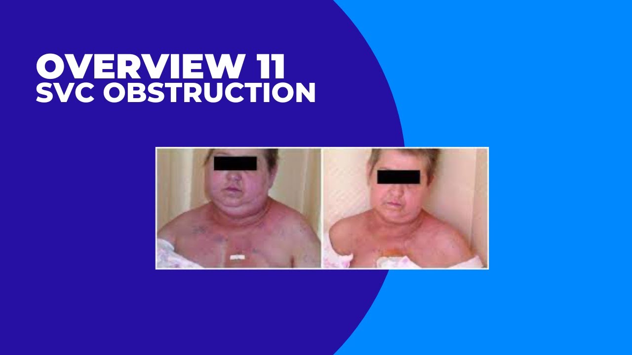 Overview 11 :  Superior Vena Cava Obstruction