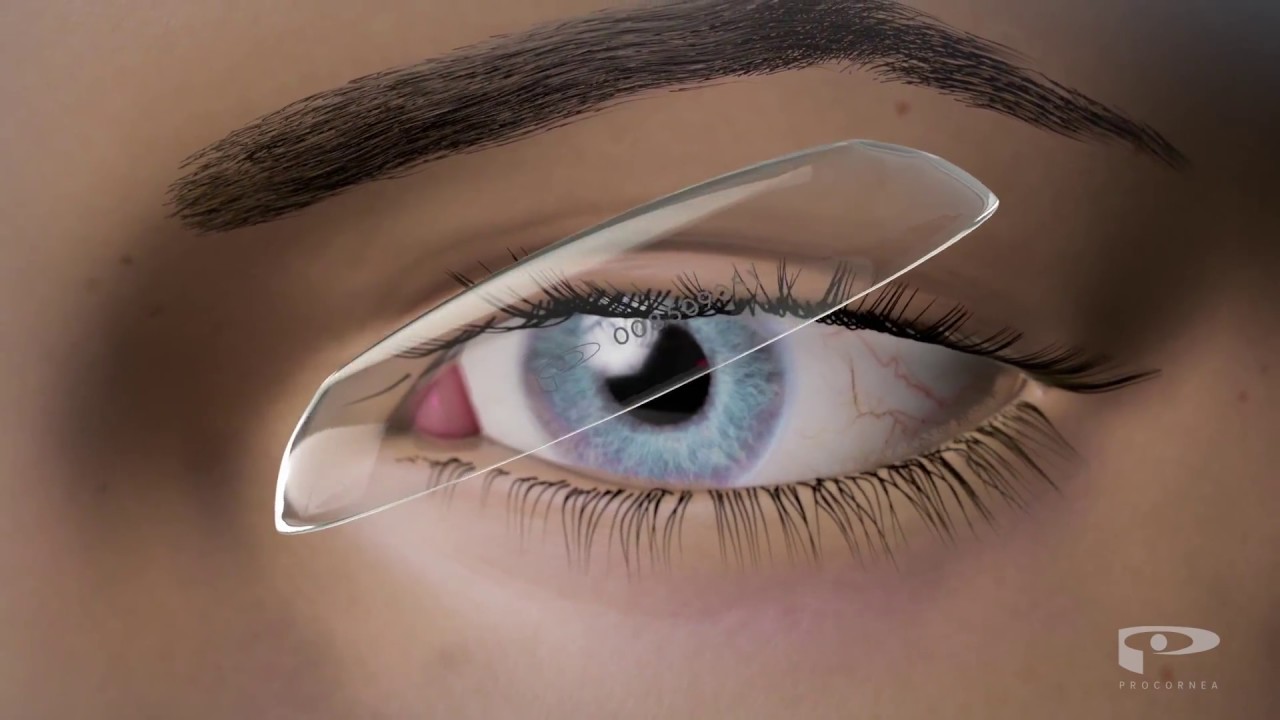 Was ist Orthokeratologie? Neu die Alternative zum Augenlasern / Augen OP