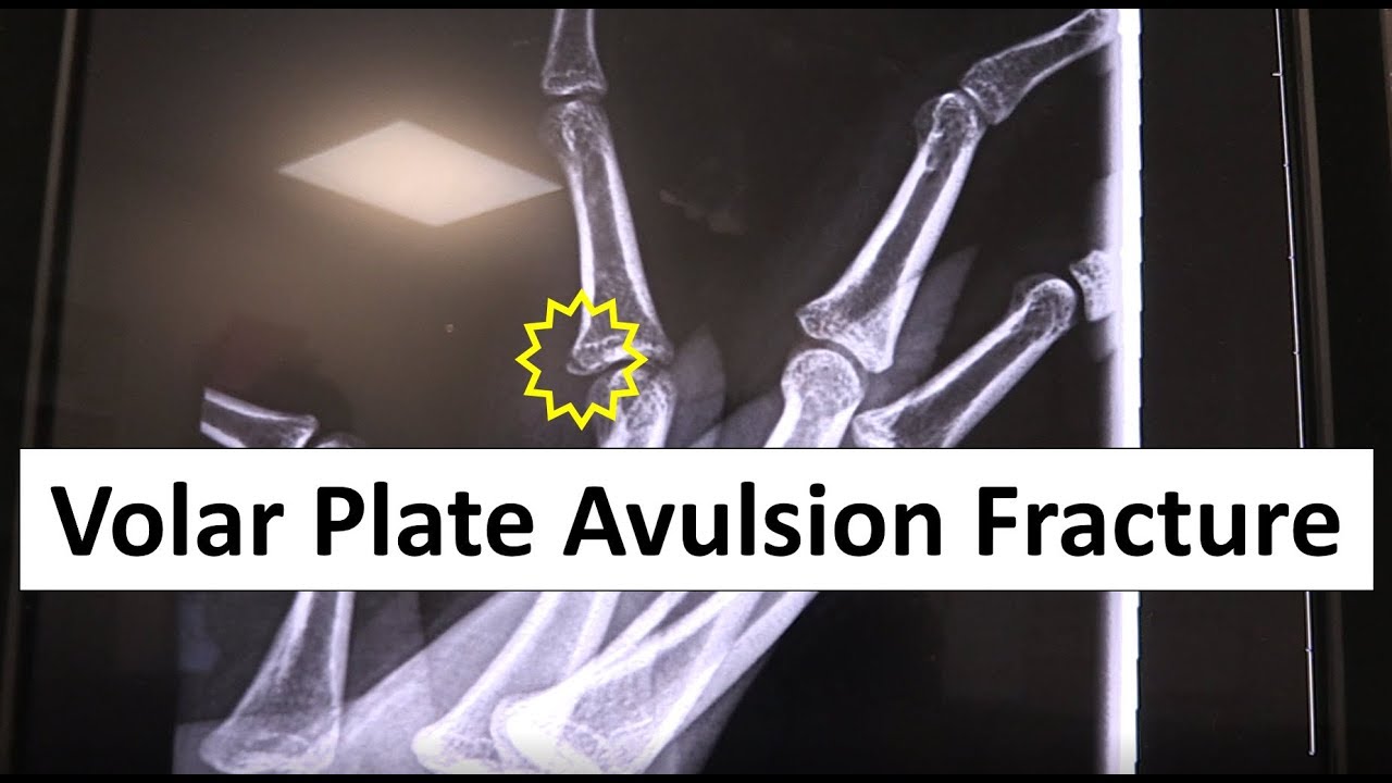 Volar Plate Avulsion Fracture Emergency