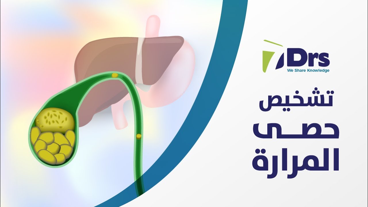 تشخيص حصى المرارة