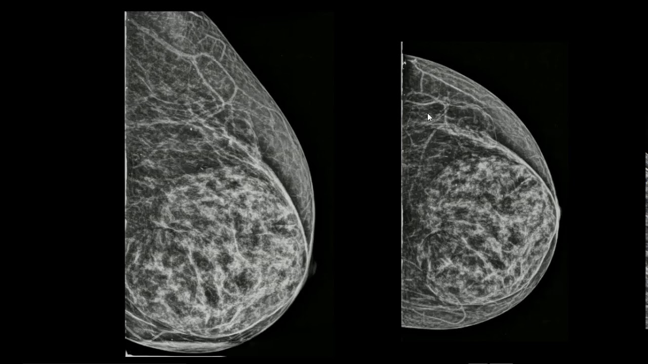 Hamartoma