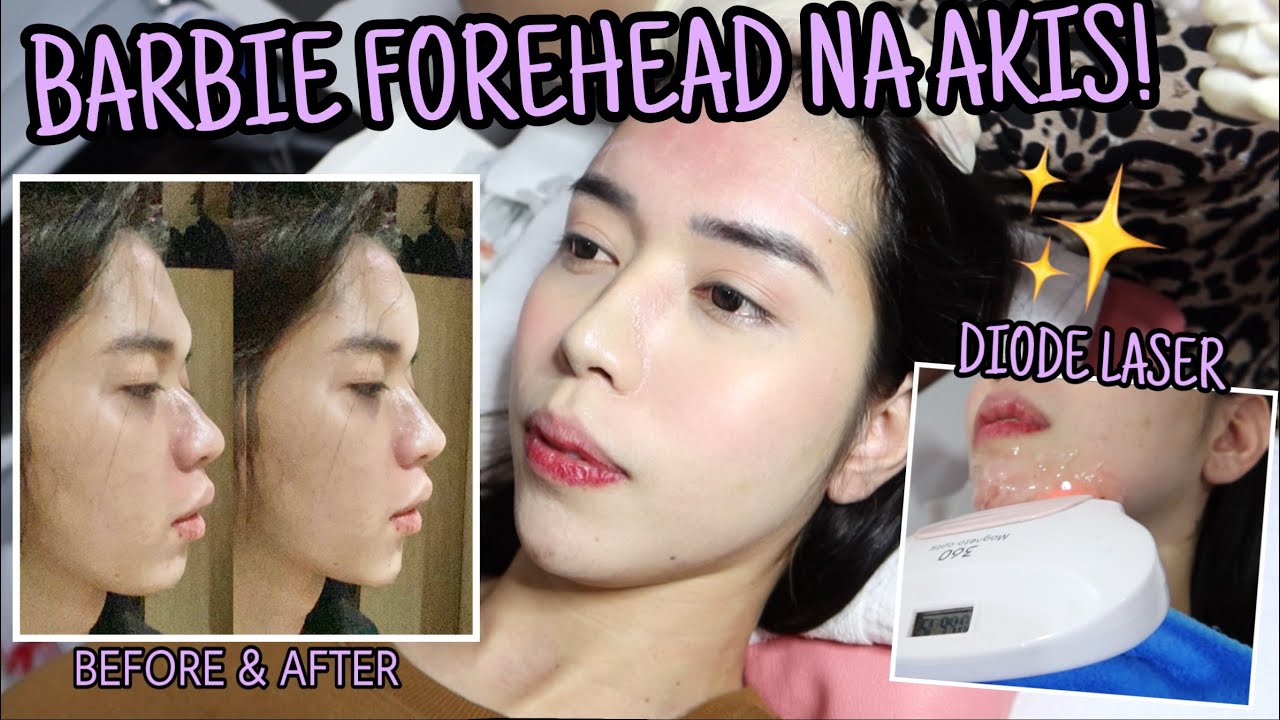 BARBIE FOREHEAD AUGMENTATION USING FILLER BUUUGSH PROFILE PLASTY YARN!😍 Prt2 || VLOG#147 JanaLarman
