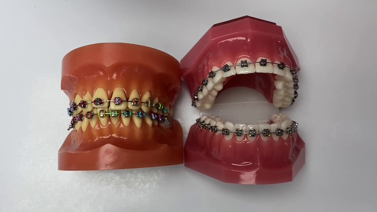 What can I do if I have broken or loose bracket?