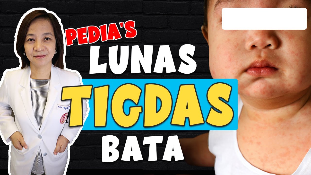 Mommy's Guide: Pano gamutin ang TIGDAS at Kailan dapat dalhin na sa Hospital || Doc-A Pediatrician