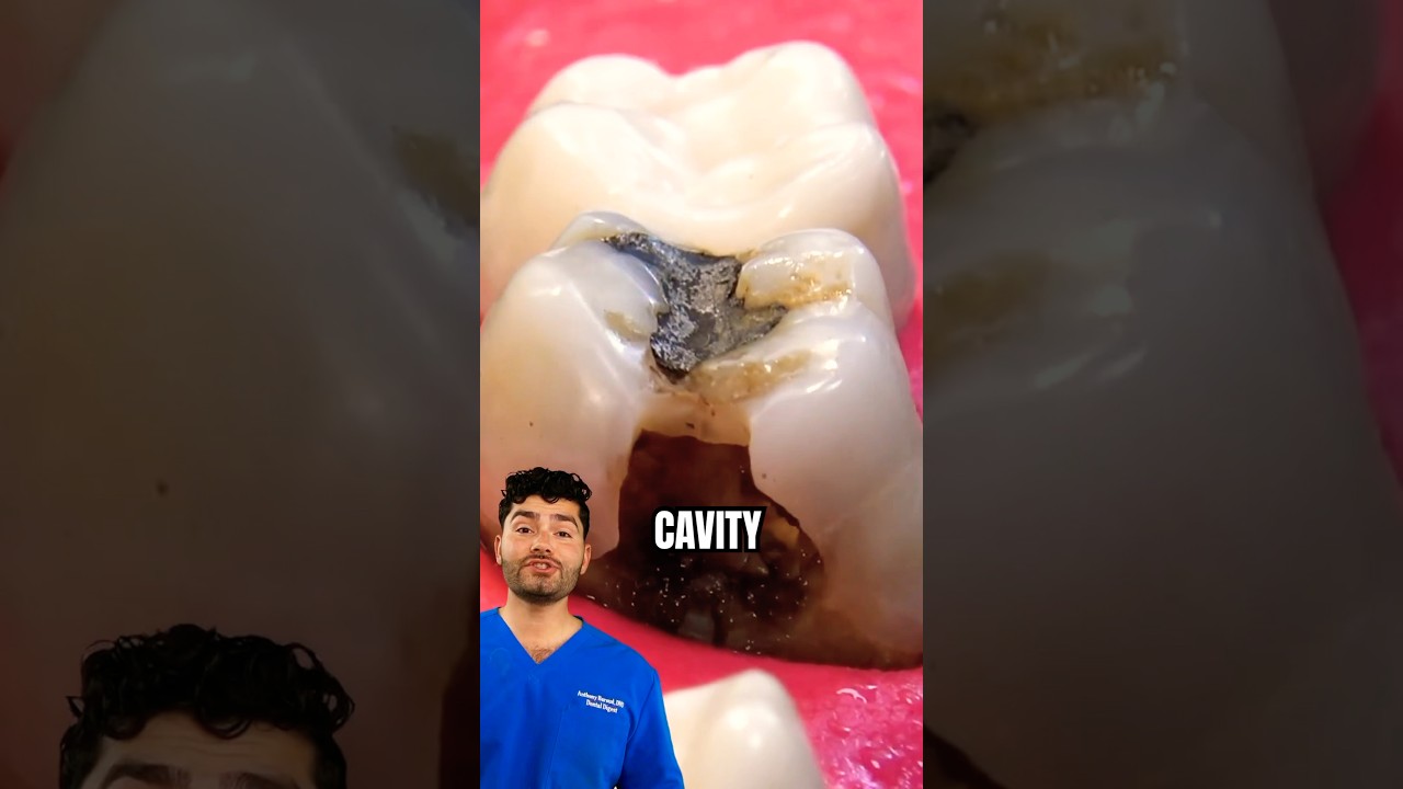 Dentist Explains: How To Fix A Cavity !?