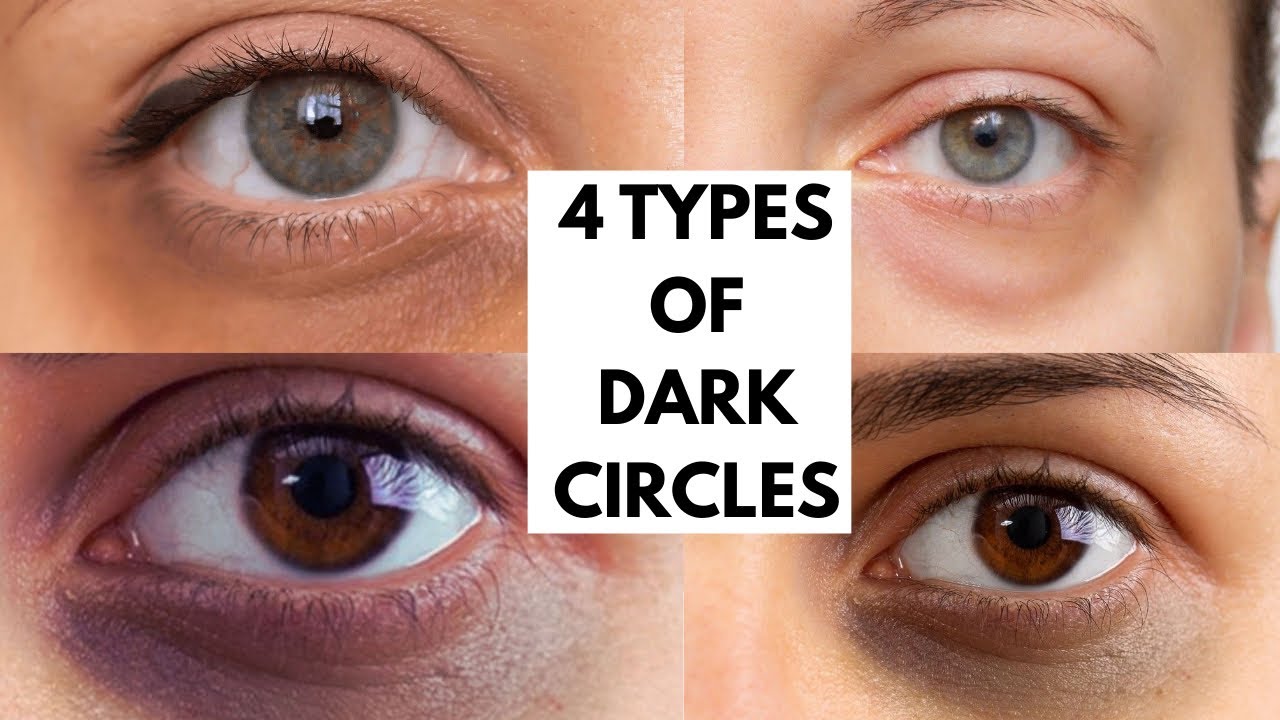 😱 4 Types of Dark Circles You’re Treating Wrong (Fix Them Now!)