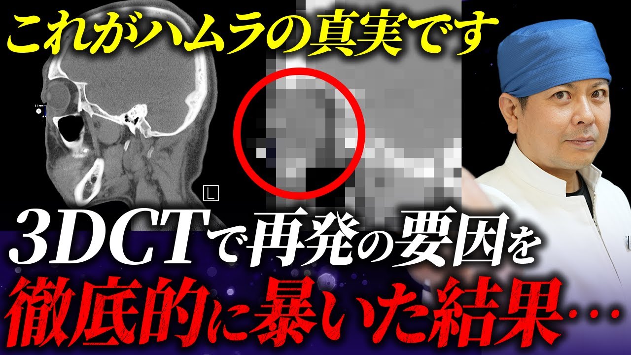 水の森美容クリニックで表ハムラを受けて再発してしまった29歳の患者様…その再発理由について3DCTを使って徹底的に解説します。【②CT解説編】
