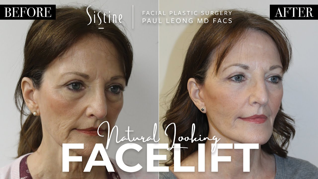 Facelift | Achieving a Natural Look