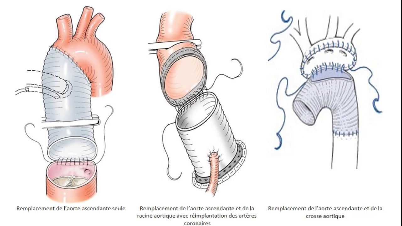 Chirurgie cardiaque | LES DISSECTIONS AORTIQUES AIGUES