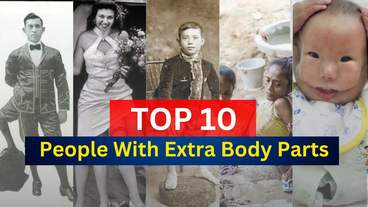 Top 10 People With Extra Body Parts - Hkworldwide | 10 People With Extra Body Parts - hkworldwide