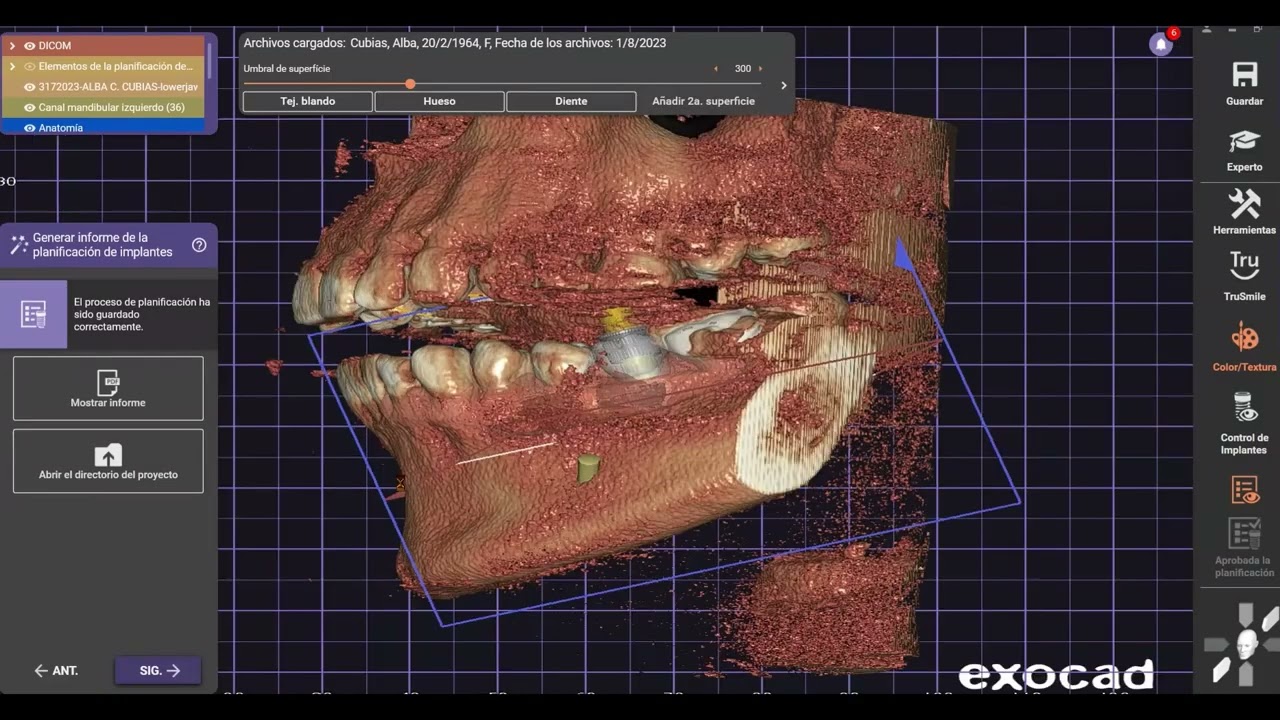 ELABORACION DE GUIA QUIRURGICA EXOPLAN