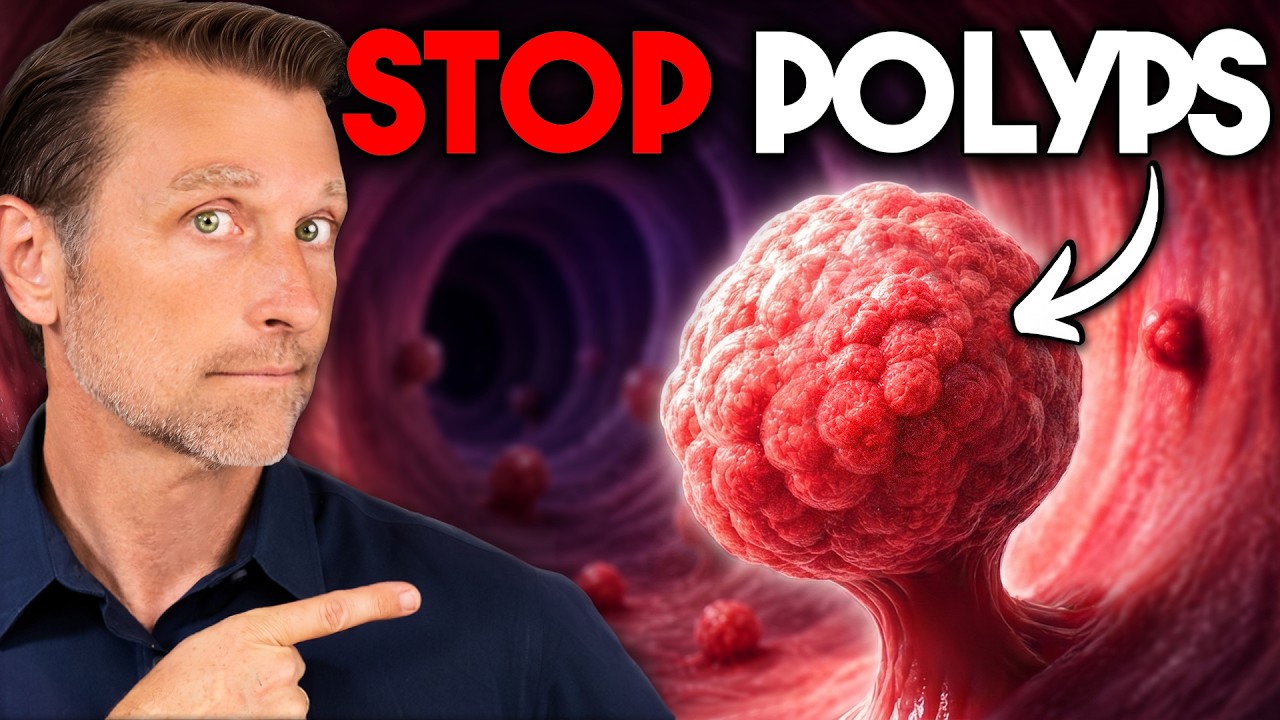 What is a Polyp? – The Best Food for Colon Polyp Prevention – Dr. Berg