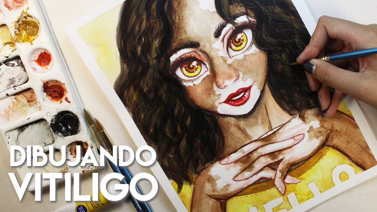 Vitiligo Girl | Diana, el Vitiligo y la inspiración vuelve poco a poco | Diana Díaz