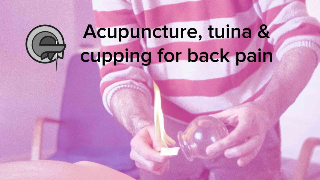 Acupuncture, tuina (Chinese massage) and cupping for back pain