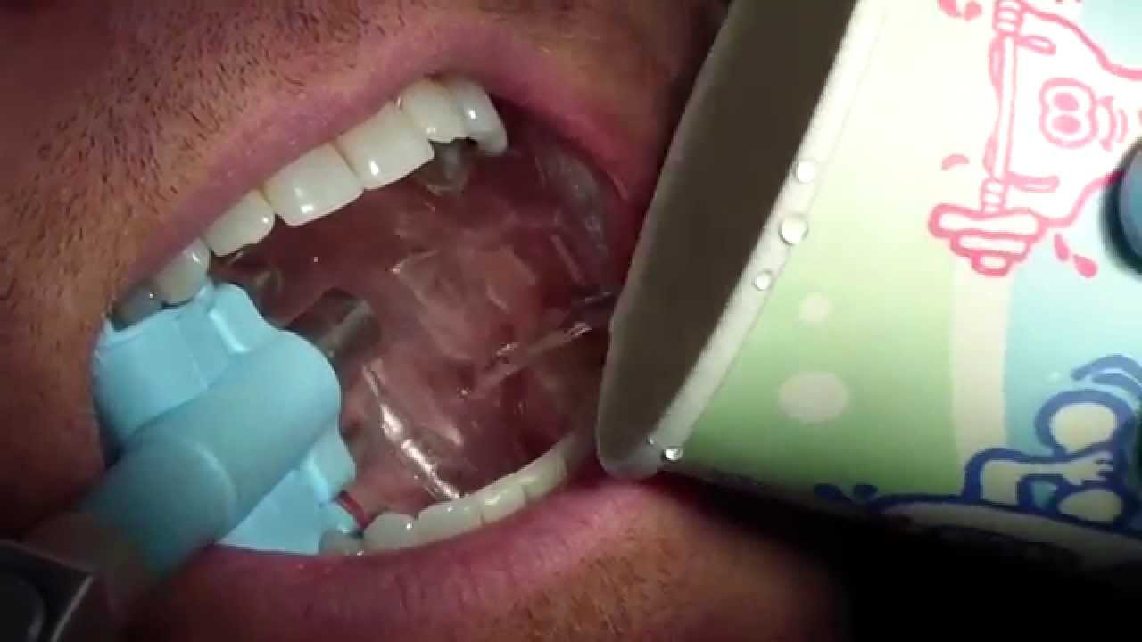 How to use EZ DAM in your dental office
