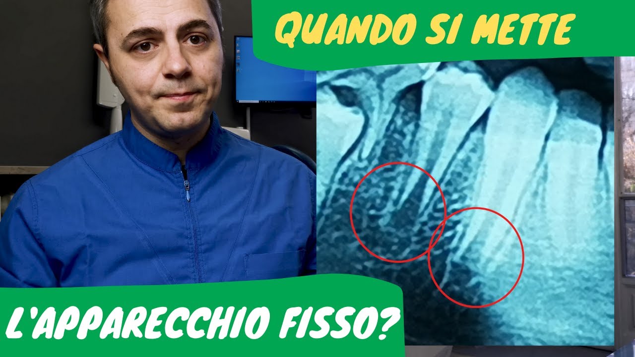 A che età si mette l'apparecchio fisso?