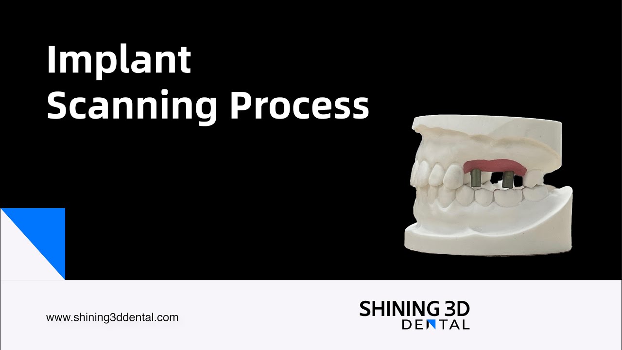 Implant Scanning Process