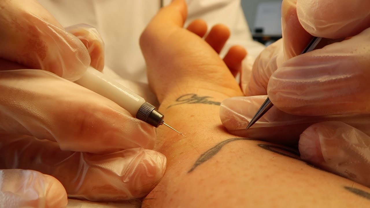 FTM Phalloplasty: Electrolysis Session