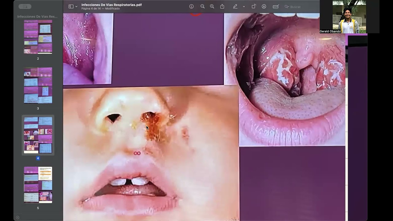 Inf. vias respiratorias pedia