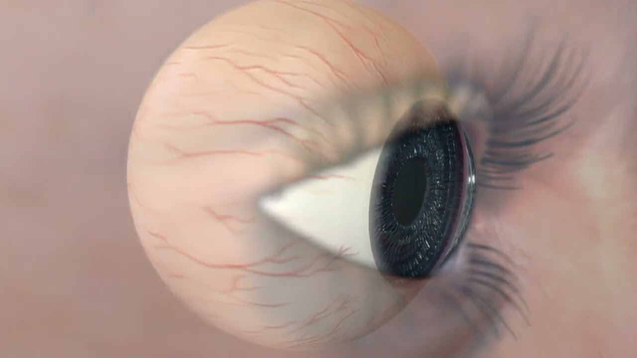 Animaci&oacute;n: La retinopat&iacute;a diab&eacute;tica