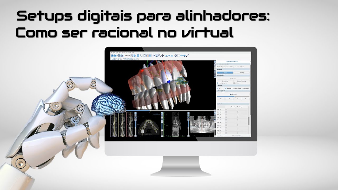 Setups digitais para alinhadores: como ser racional no virtual