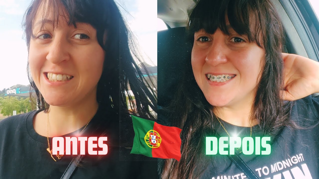 Colocando Aparelho pela Primeira Vez em Portugal | Dói? Preço? Experiência Real 