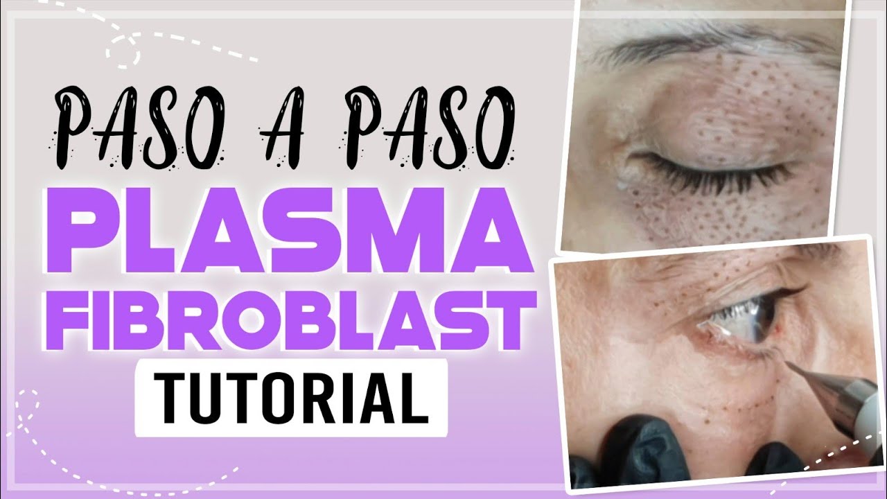 PLASMA PEN PÁRPADOS. #plasmapen #plasma #fibroblast