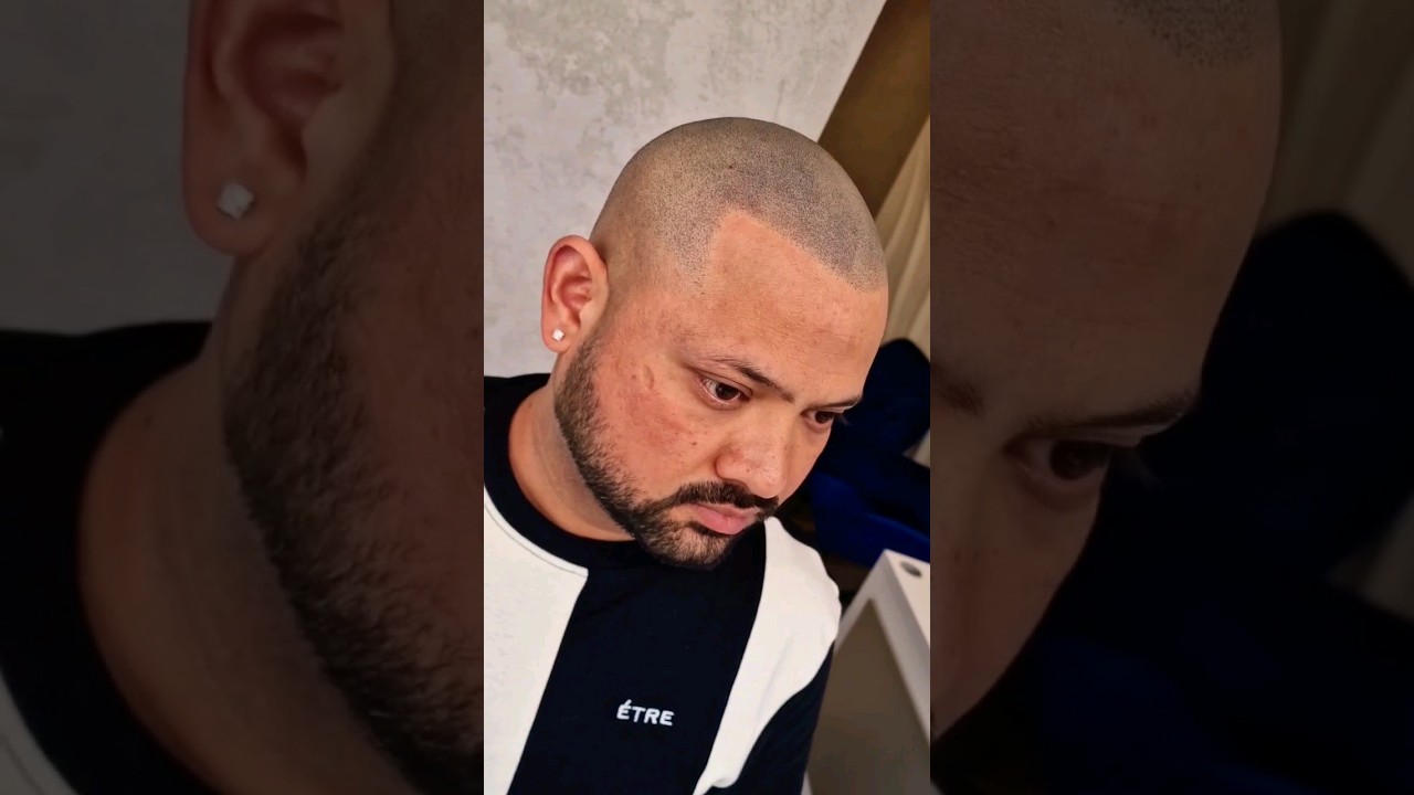 🔥HAIRLINE UPGRADE🔥HAIR TATTOO ON INDIAN SKIN #smpstudiouk #smphairclinic #hairtattoo #smpartist