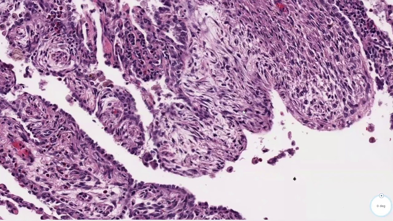 Lymphangioleiomyomatosis (LAM)
