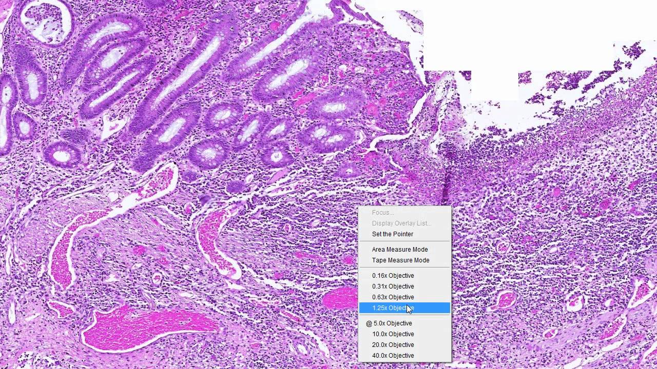 Crohn's Disease