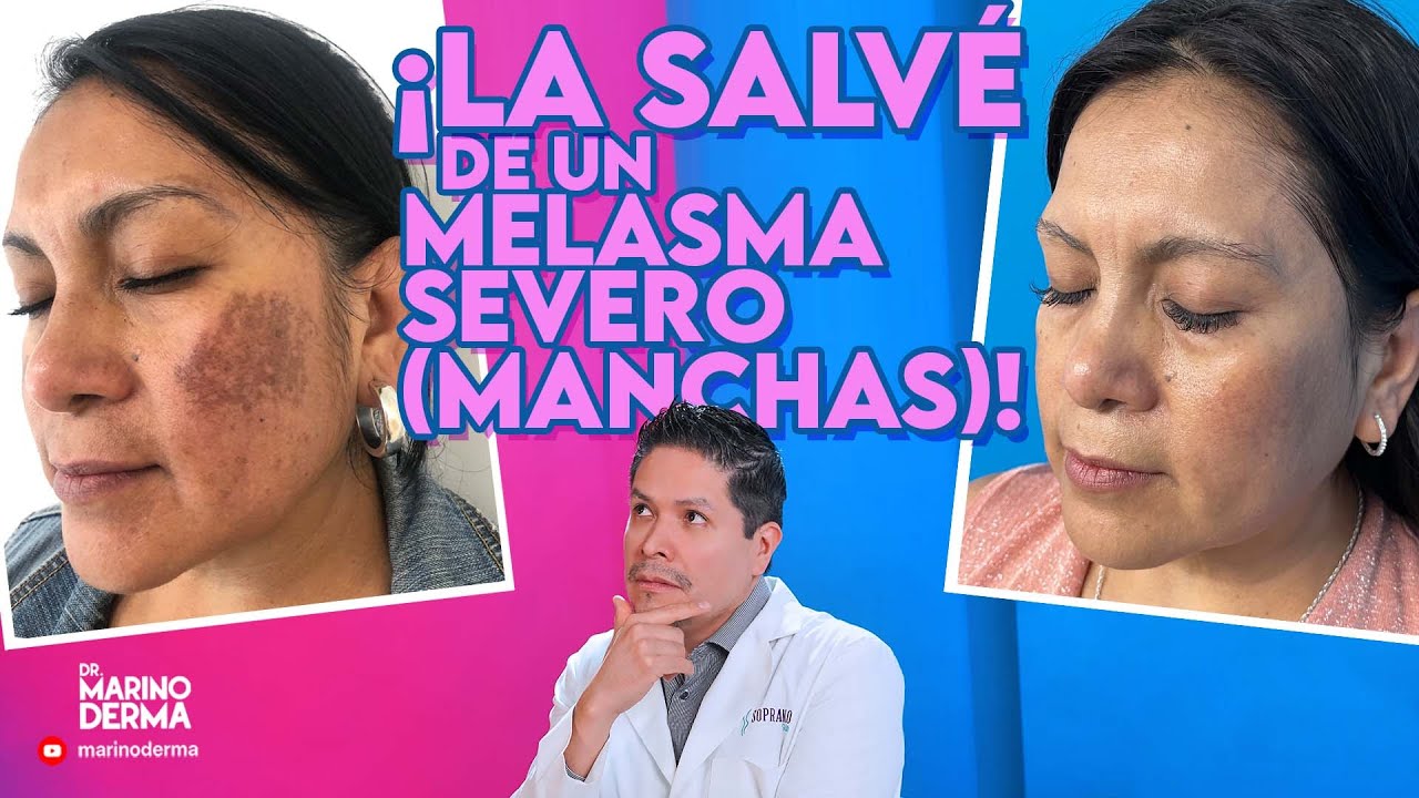 LA SALVE DE UN MELASMA SEVERO (PAÑO) - Dermatologo tips