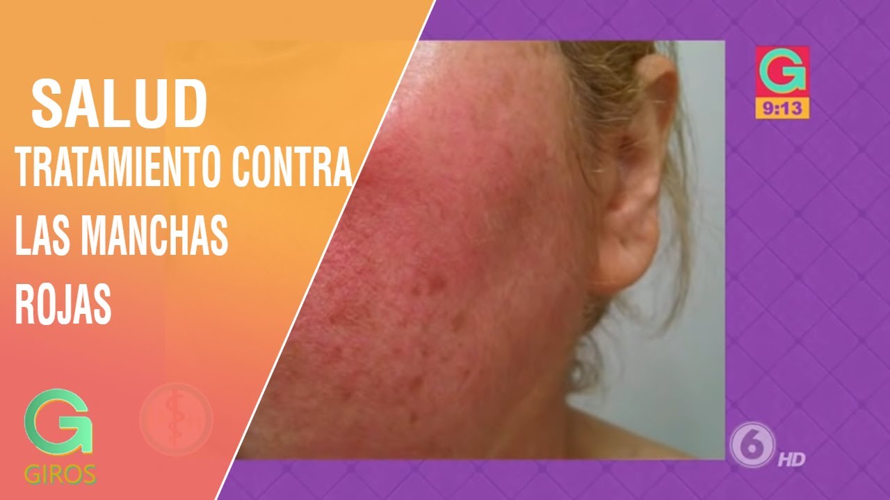 Tratamientos contra las manchas rojas y escamas en la piel | Salud