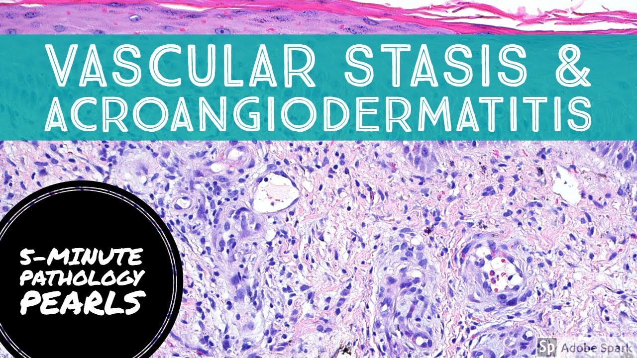 Pseudo-Kaposi sarcoma (Acroangiodermatitis aka Severe Stasis): 5-Minute Pathology Pearls