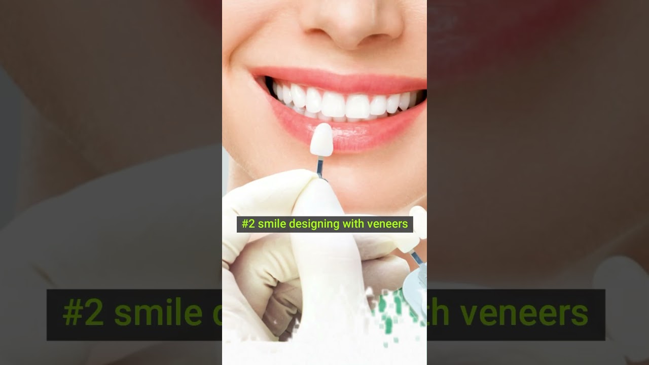 Bride smile makeover at Opal dentistry #dentist #teethwhitening #invisalign #smiledesigner